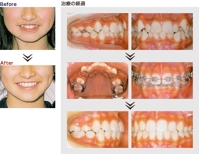 歯科 矯正 ビフォー アフター