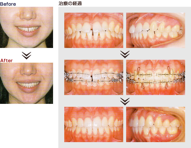 矯正 ビフォー アフター